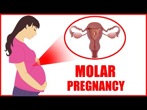 Molar Pregnancy – Molar Pregnancy Symptoms || Common Signs Causes and Treatment Risks