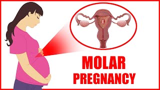 Molar Pregnancy – Molar Pregnancy Symptoms || Common Signs Causes and Treatment Risks