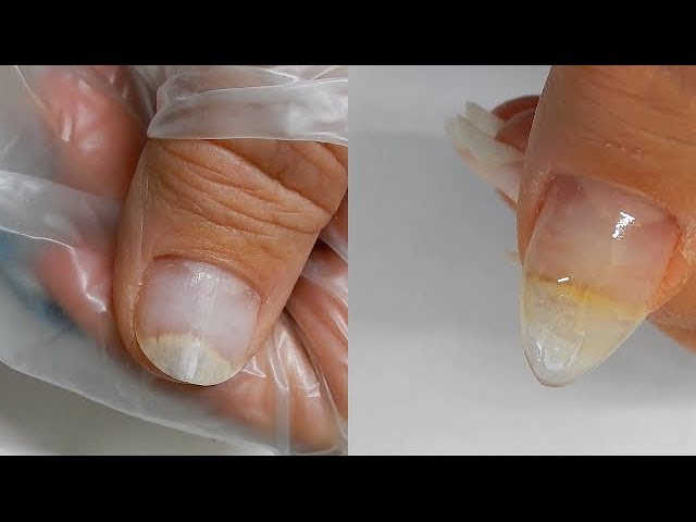 It's a Miracle ! -- Thumb Nail is Re - Attaching to Nail Bed --- w/ Help  from TEA TREE OIL - YouTube