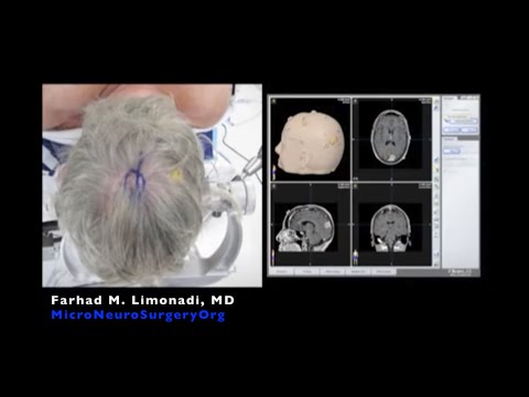 meningioma surgery occipital brain removal