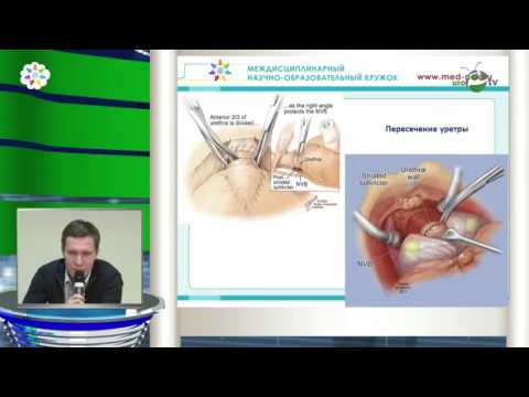 Печеркин А А - Радикальная простатэктомия