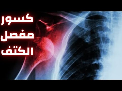كسور مفصل الكتف كسر اعلى عظمة العضد كسور الكتف كسر رأس عظمة العضد دكتور احمد حسن جمعه