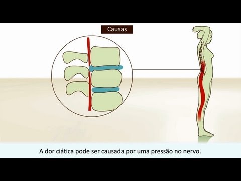 Ciática - O que é a dor ciática e como você pode tratá-la?