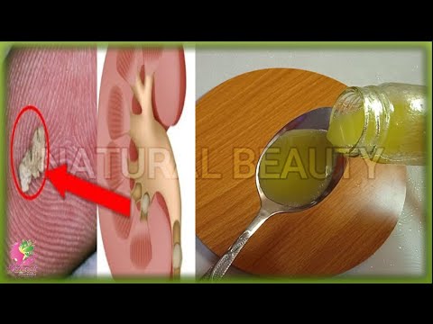 Remove kidney or gallbladder stones in 3 days without surgery