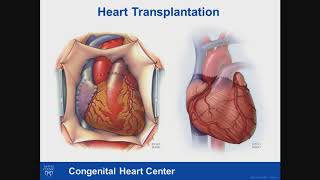 Adult Congenital Heart Disease – Heart Transplantation: Failing Fontan Circulation