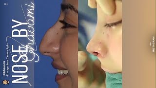 MY NOSE JOB EXPERIENCE! (Price, pain, recovery)