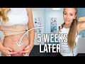 5 Weeks Post opp Tummy Tuck Update (Mom of 4)