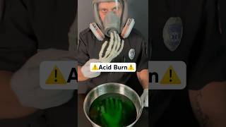Burned by acid Try this… #survival #health #medical