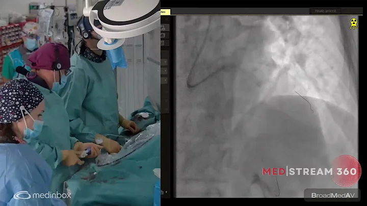 PCI To LAD Using IVL Under OCT Guidance