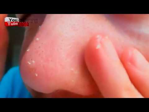 Compilation of Plucking, yanking and extraction of ingrown hairs, Popping pimples and blackheads !