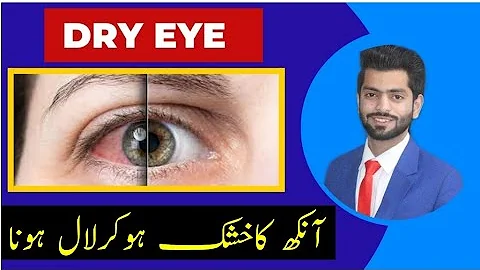 Dry Eye | Causes, Symptom, Treatment of Dry Eye | Ankh ka Lal hona | Ankh ka ilaj |