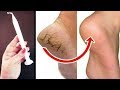In Just 5 Minutes - Get Rid of CRACKED HEELS Permanently, Magical Cracked Heels Home Remedy