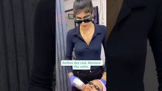 Photo facial for rosacea treatment at Myra skin & hair solutions #rosácea #medifacial #laser #ipl