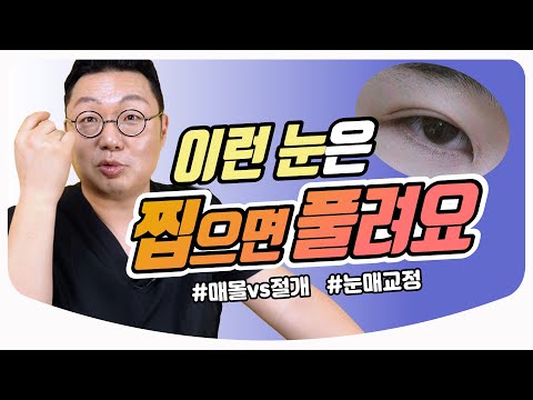 눈성형 마스터 하(下) / 나에게 딱 맞는 눈 수술 찾는 법! / 매몰, 눈매교정, 절개  | 성형외과 전문의 전경욱 원장