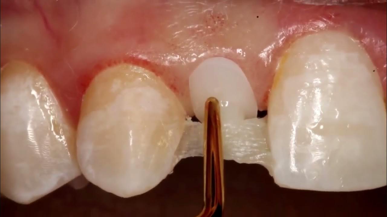 How to create a Direct Resin Bonded Bridge XBD YouTube