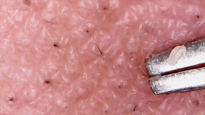 顎の角栓 2 Youtube