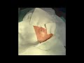⑤ 粉瘤くりぬき法 epidermal cyst atheroma cystic acne extractions 脂肪腫 lipoma 大阪心斎橋　大阪梅田院　名古屋栄え院　福岡天神院　尼崎院西宮院