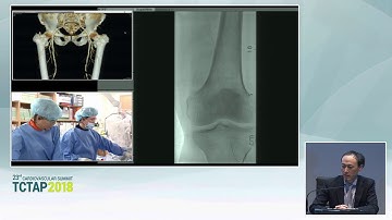 [TCTAP 2018] Endovascular Symposium - Live Case Session III