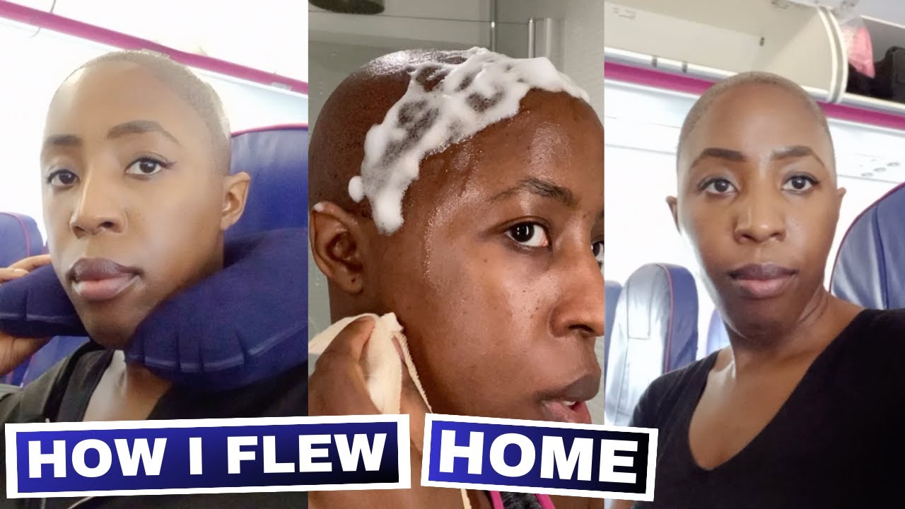 FUE Transplant Day 3 Hair transplant foam, swelling, bald at the
