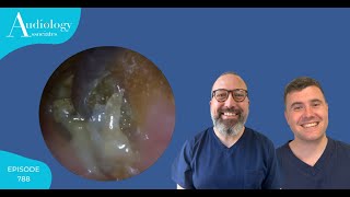 CRUSTY HARD EAR INFECTION REMOVAL  EP788