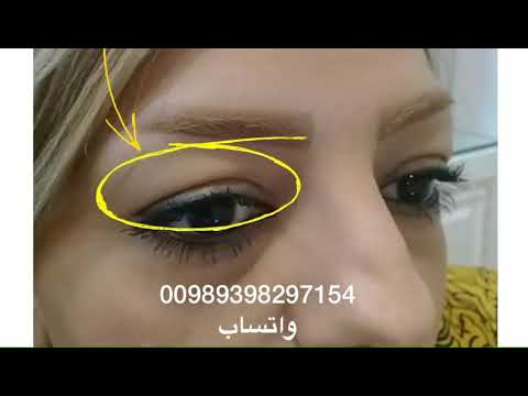 قص الجفون في ايران مع الدكتور وحيد سنجري عمليات تجميل الجفون في ايران جفون العلويه والسفليه