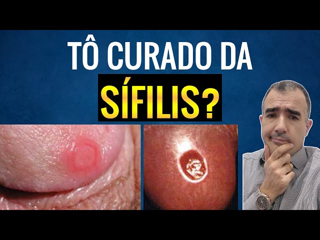 Sífilis pode ser fatal se não for tratada - Seconci-SP