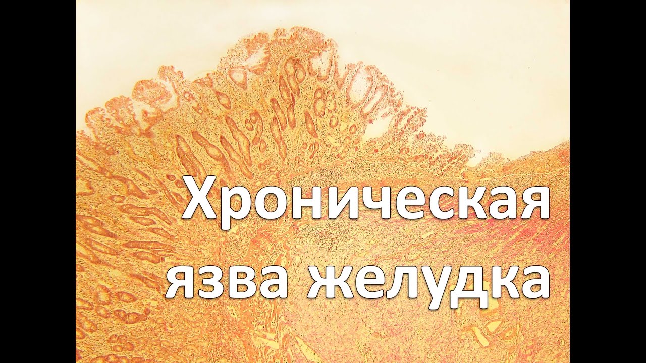 Хроническая язва желудка | Патанатомия - YouTube