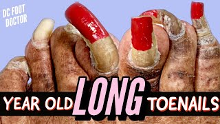 Year Old Long Toenails: Trimming Extremely Long Toenails