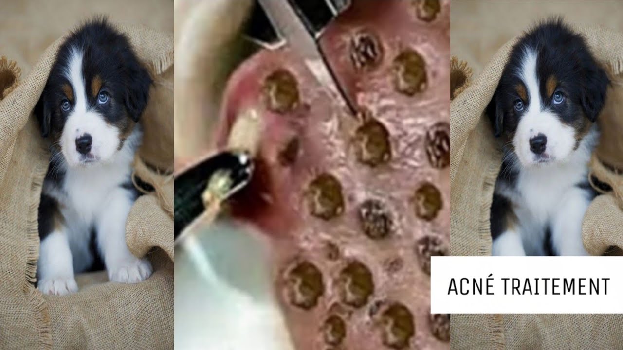 Extraction point noir, acné, kyste en profondeur 20 YouTube