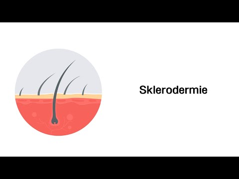 Video: Systemische Sklerodermie - Diagnose, Behandlung, Prognose