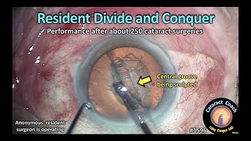 CataractCoach 1596: resident divide and conquer