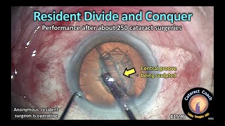 CataractCoach 1596: resident divide and conquer screenshot 5