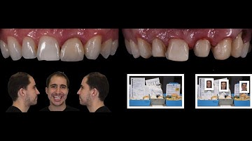 Diagnostic Communication and Material Overview with Peter Pizzi, CDT, MDT