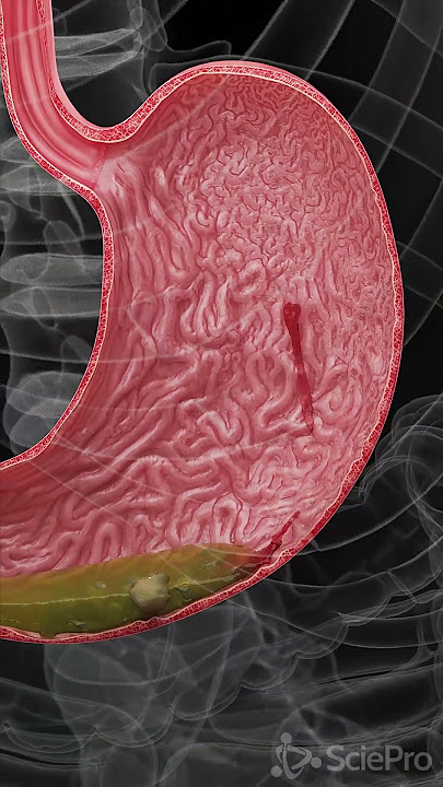 Understanding Hemorrhagic Gastric Ulcers  #anatomy #meded #3danimation