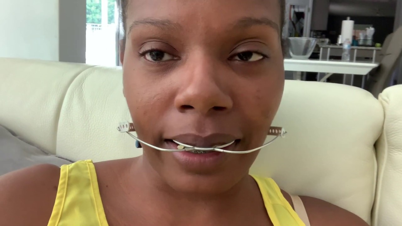 Braces Adjustment YouTube