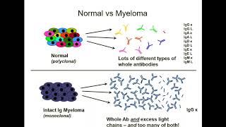 Following & Understanding Your Free Light Chain Test Results in Multiple Myeloma