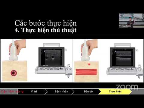 Siêu âm hướng dẫn thủ thuật thiết lập đường truyền tĩnh mạch trung tâm | ThS. BS. NGUYỄN BÍCH TRĂM