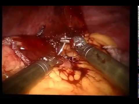 Robotic sleev gastrectomy. Продольная (рукавная, вертикальная) гастропластика.