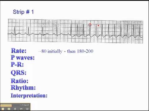 ECG: Exercise # 1