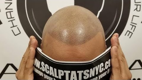 2021. scalp micropigmentation results New York city.