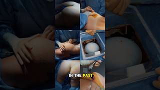 Butt Implants. Do people really get them? #buttockaugmentation #drjohnnyfranco