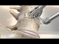 STALIF M™ (MIDLINE II) Surgical Animation