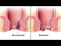 ★Раствор марганцовки и отвар горца для лечение геморроя