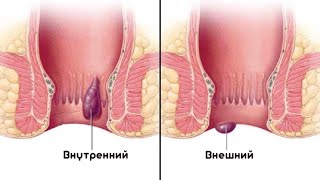 ★Раствор марганцовки и отвар горца для лечение геморроя