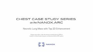 Clinical Case Study | Necrotic Lung Mass with Tap2D | Nanox Vision