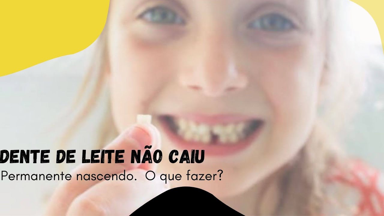 Dente permanente nascendo e de leite não caiu. O que fazer? - YouTube