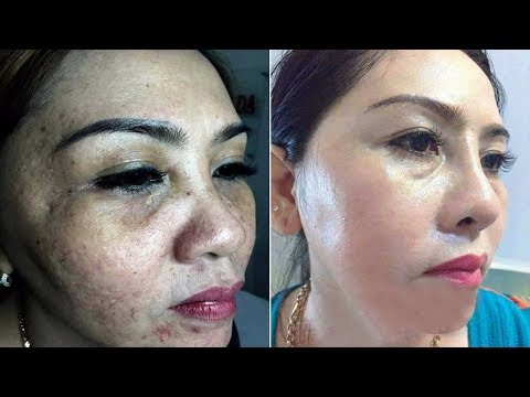 Bí quyết trị dứt điểm tàn nhang vĩnh viễn không lo tái phát 100 người thì 99 người không biết