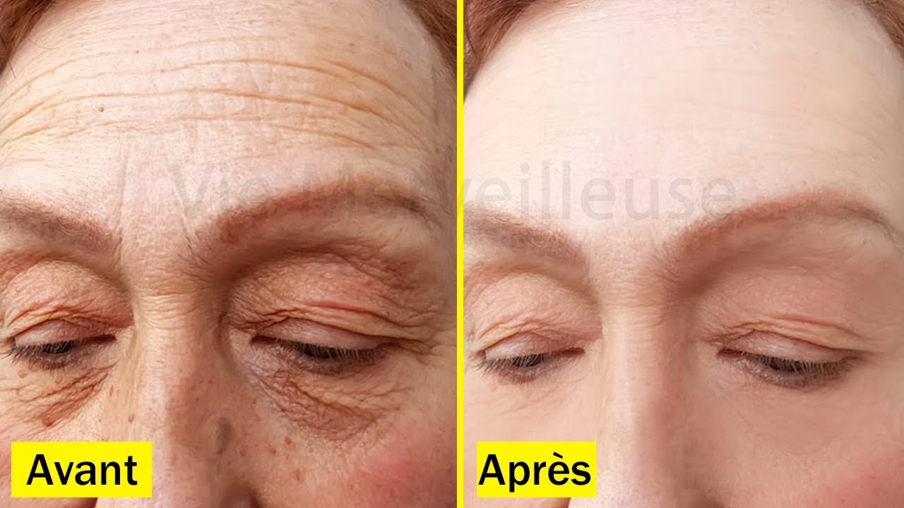 Se Debarrasser Des Rides En 7 Jours Avec Cette Recette Et Vous Deviendrez 10 Ans Plus Jeunes Youtube