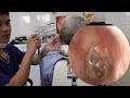👂💤 耳かき | 耳掃除 | 老人の耳の中の虫