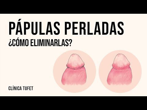 Pápulas perladas ¿Cómo eliminarlas?